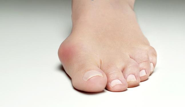 Best Sandals for Bunions